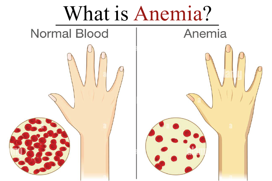 what is anemia